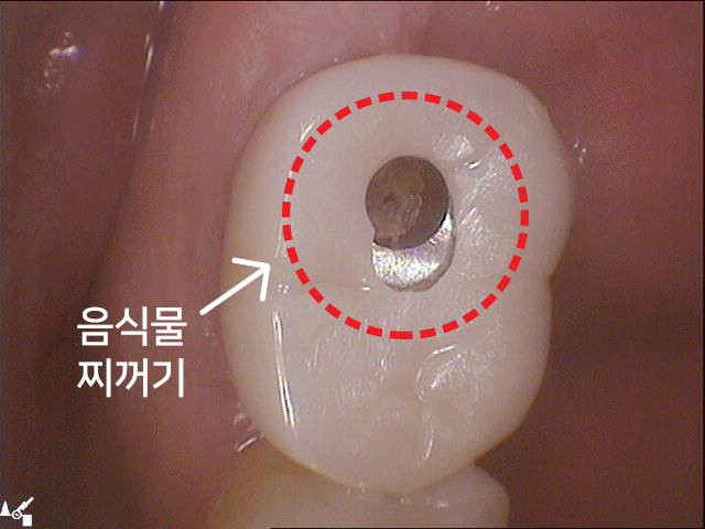 임플란트 구멍(홀)이 났는데 어떻하죠? 관련 이미지 7