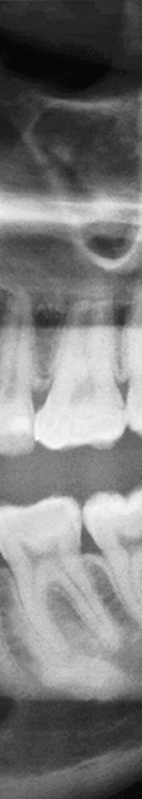 신논현역치과 사랑니 발치를 원한다면 관련 이미지 12