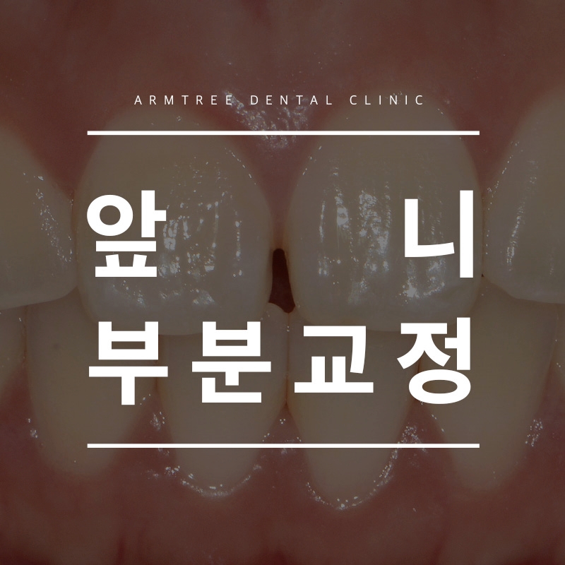 앞니부분교정 빠르게 진행하려면! 신논현역 아름드리치과 관련 이미지 1