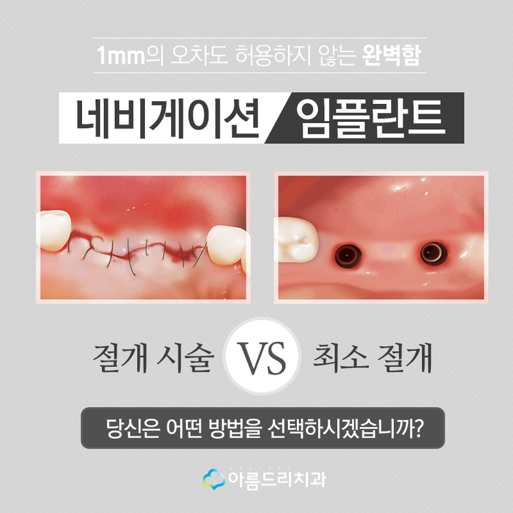 네비게이션임플란트 부작용은 저리가 관련 이미지 4