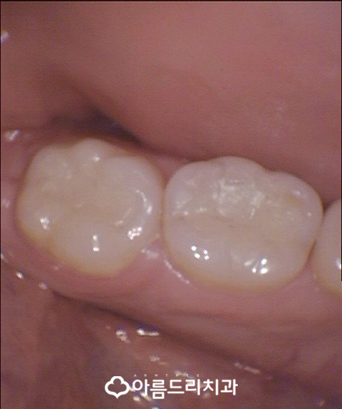 충치인레이 아말감주변 충치치료는? 관련 이미지 10