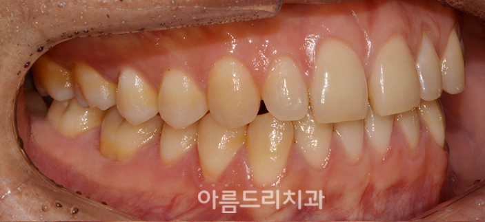 벌어진앞니부분교정 짧은기간 치아교정 관련 이미지 4