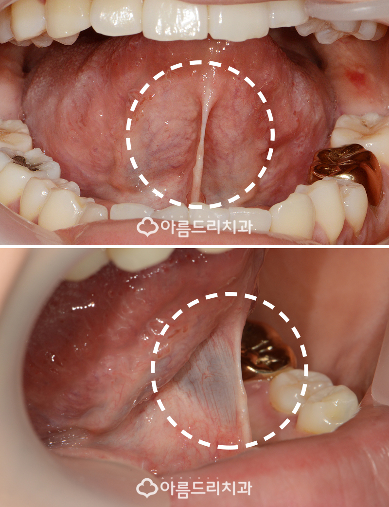 성인 설소대수술 비용 리얼후기 관련 이미지 3