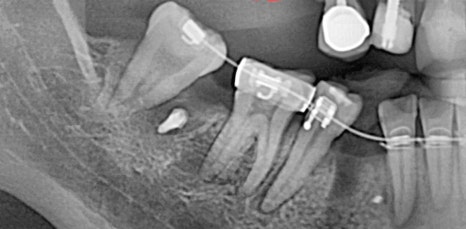 신논현역임플란트 아름드리치과에서 상악동거상술이 필요하면 관련 이미지 8