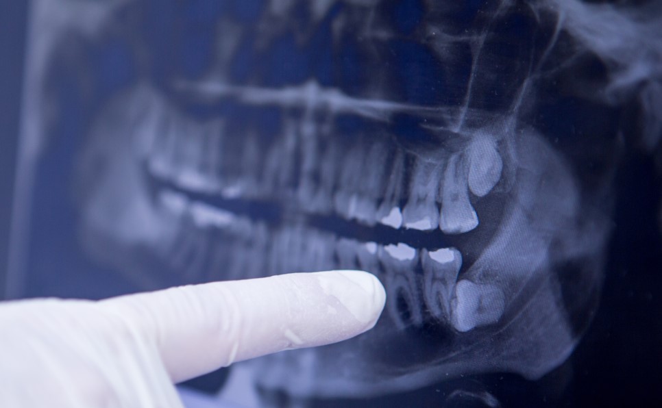 강남 아름드리치과 수술 발치_매복치 신논현치과 관련 이미지 1