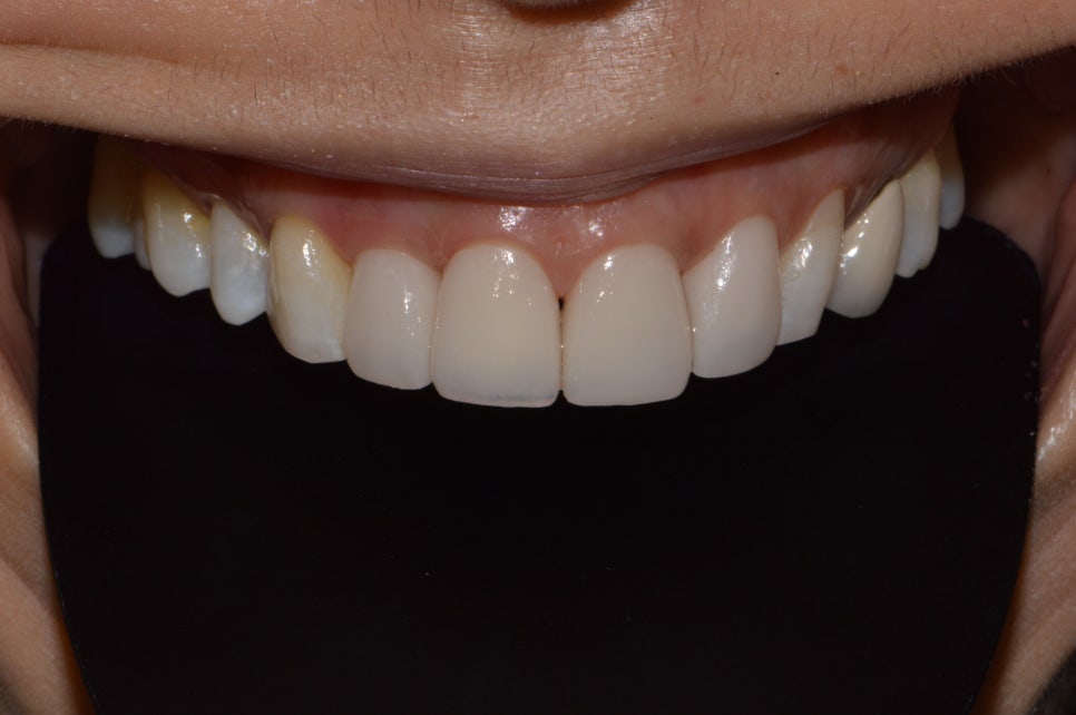 [신논현 치과] 3D 구강 스캐너_정확하게 본뜨기 관련 이미지 15