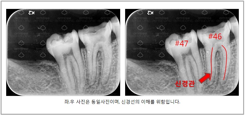 [치아 신경치료] #46,47번(오른쪽 아래 치아) 통증으로 내원 관련 이미지 5