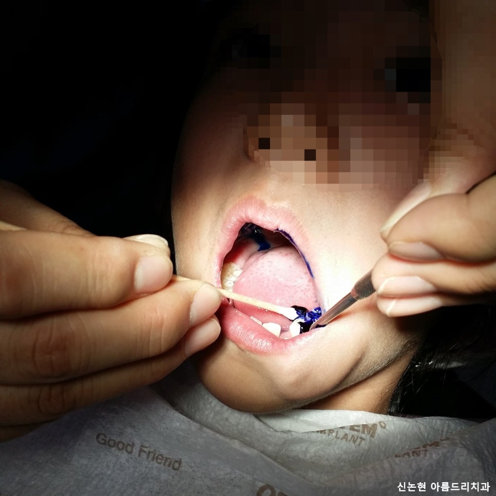 [신논현치과]어린이양치교육_구강검진_유아충치_충치예방 관련 이미지 5