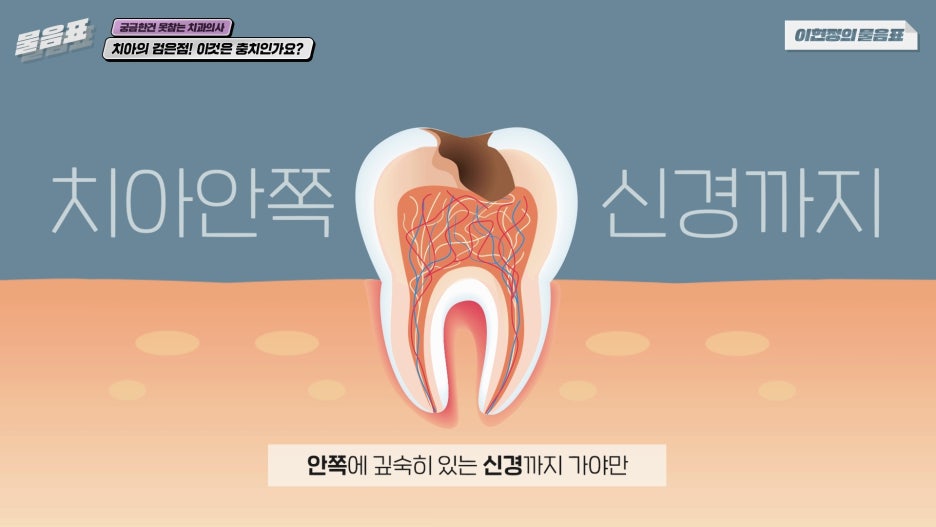 치아의 검은점 충치? 원인과 치료법! 아름드리치과 관련 이미지 9
