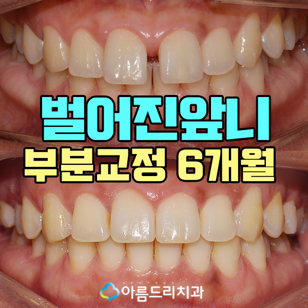 앞니벌어짐 부분교정으로 빠르게 관련 이미지 1