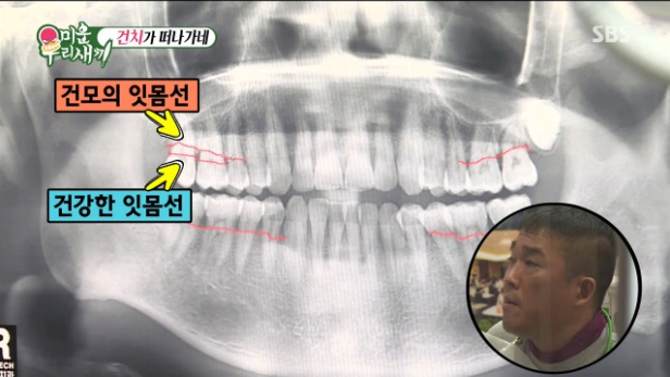 미우새 건치 김건모 풍치 이유는? 술&담배 관련 이미지 9