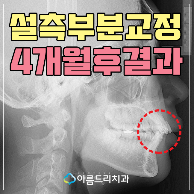 부분 설측교정비용 후기가 좋은 치과 관련 이미지 1