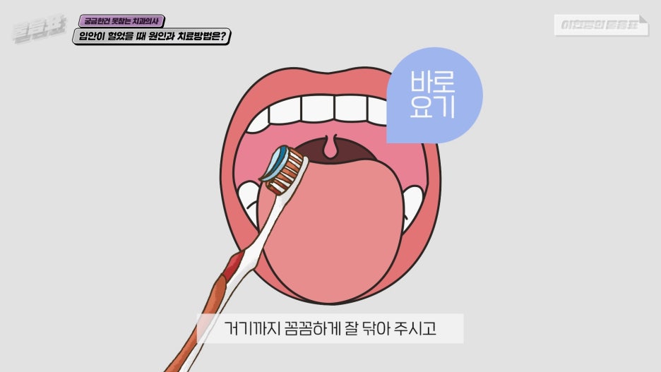 입안이 헐었을때 해결방법 이현정의물음표 관련 이미지 17