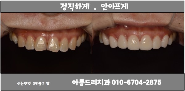 앞니 충치,앞니변색은 라미네이트로 해결(라미네이트가격문의) 관련 이미지 4