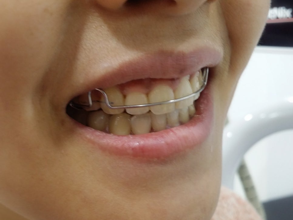 교정 완료_유지 장치 어떤 거 해야 해? 관련 이미지 2