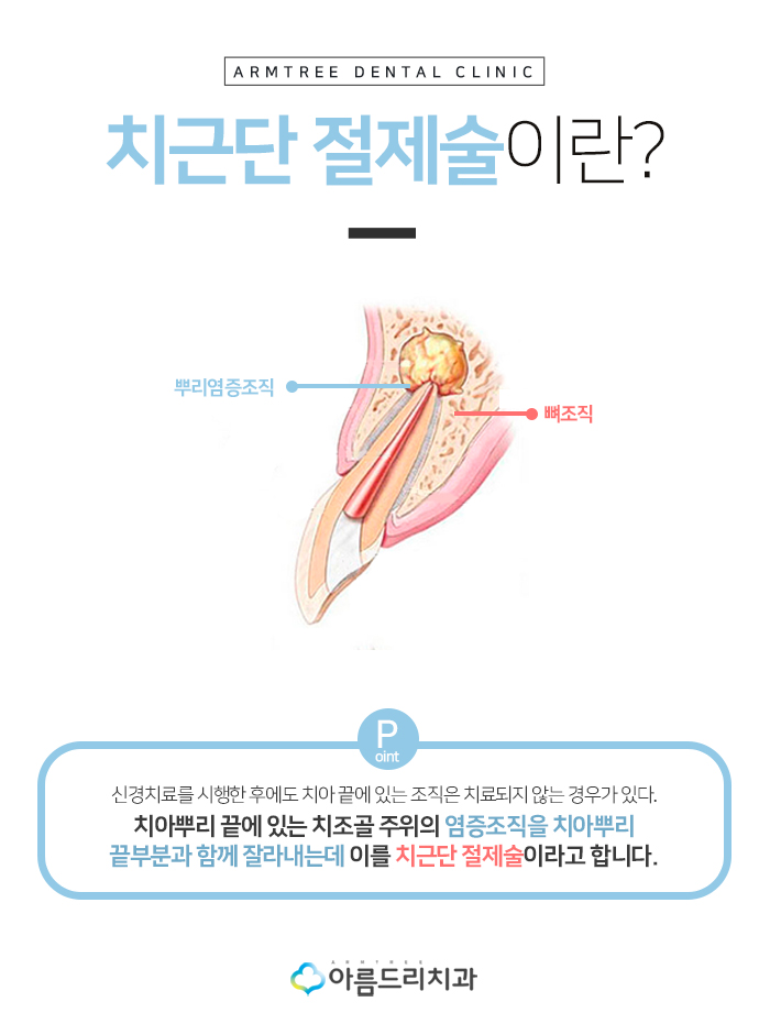 치근단절제술 후기를원한다면? 관련 이미지 5