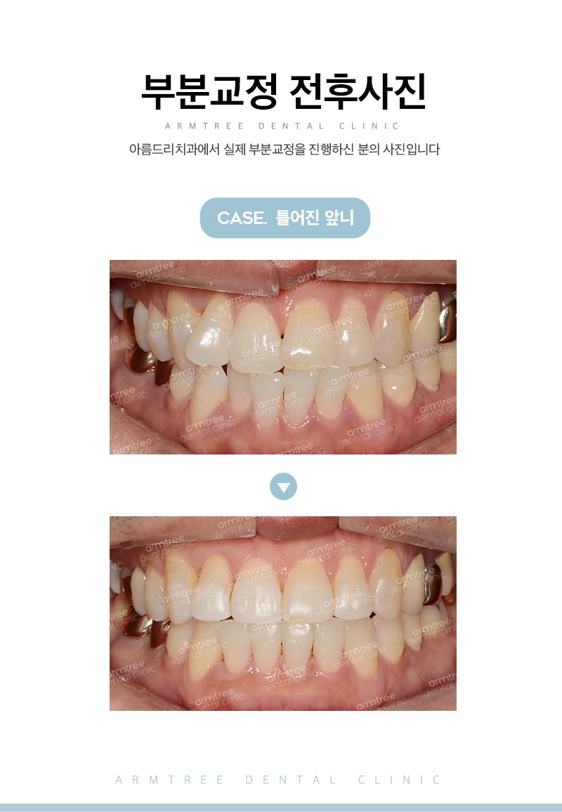 부분교정기간 다양한후기 아름드리치과 관련 이미지 11