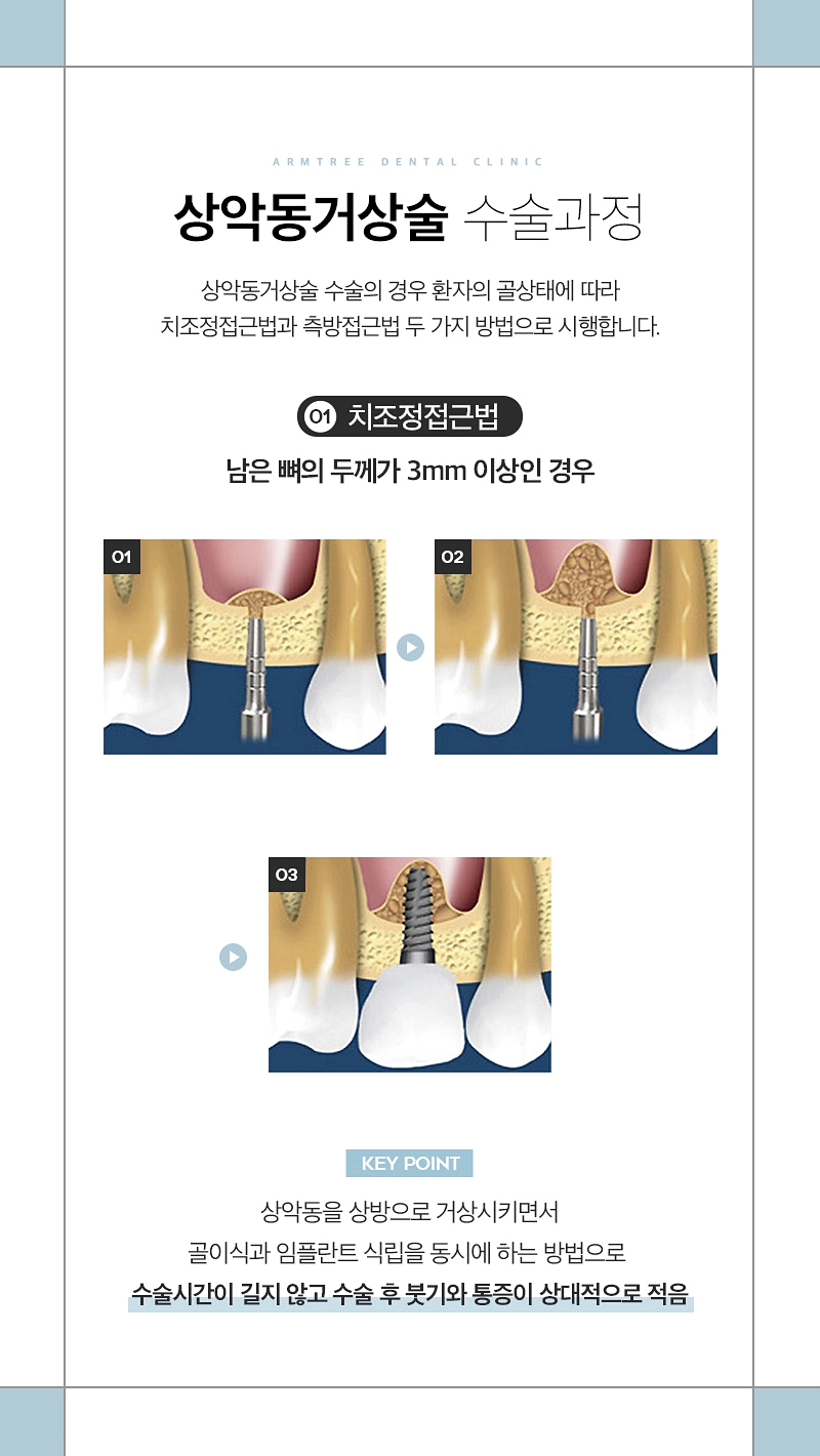 상악동거상술 부작용없는 아름드리치과 관련 이미지 4