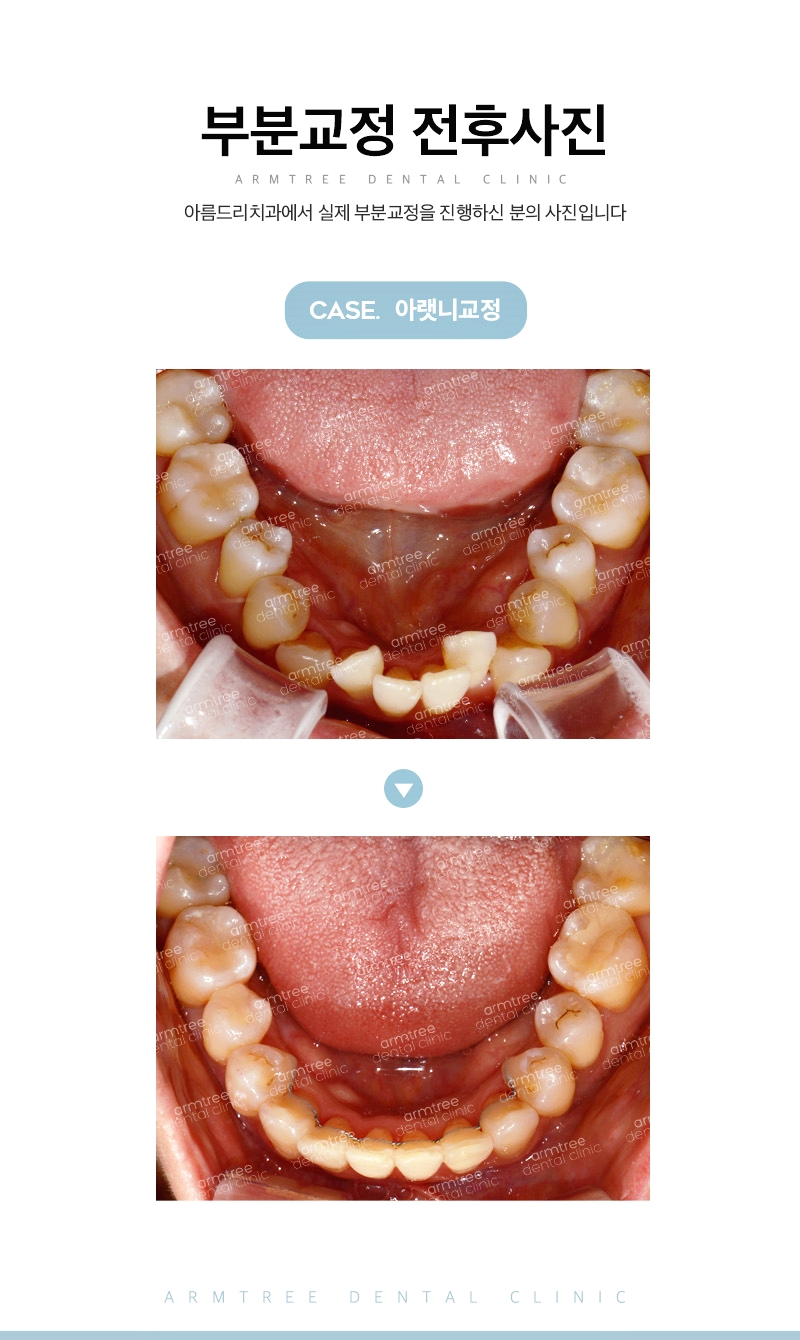 아랫니부분교정후기 현명하게 신논현역 아름드리치과 관련 이미지 11