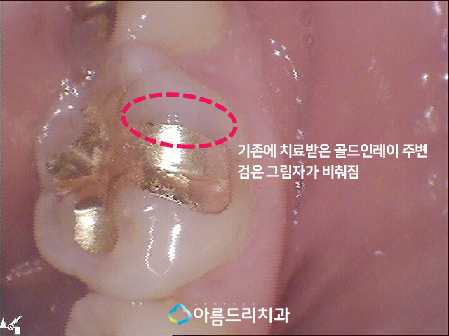 치아우식증 치료 증상과 예방법 관련 이미지 6