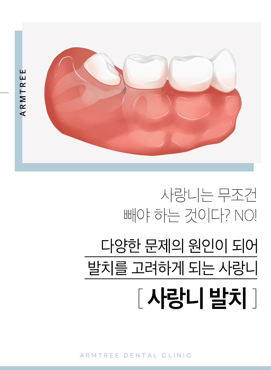 신논현 사랑니발치 선택하려면 관련 이미지 2