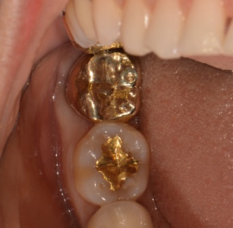 [신논현 치과] 임플란트 대신 치아재식(아름드리치과) 관련 이미지 13