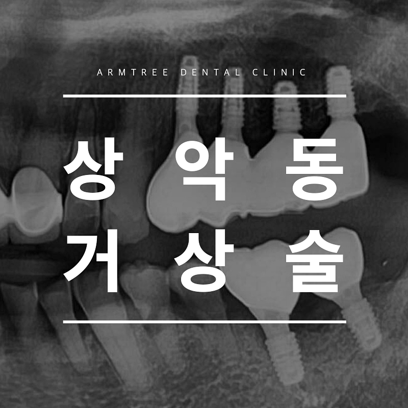 상악동거상술 부작용없는 아름드리치과 관련 이미지 1