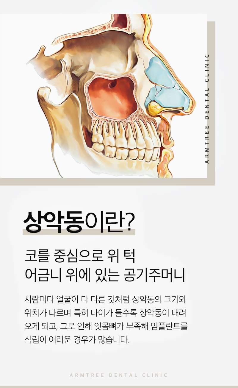 신논현역치과 상악동거상술과 임플란트는 아름드리치과에서 관련 이미지 3