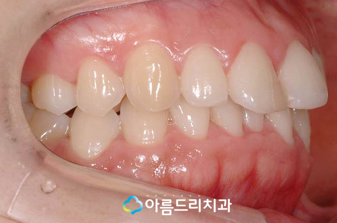 돌출입교정후기 급속으로 입툭튀 안녕 관련 이미지 3