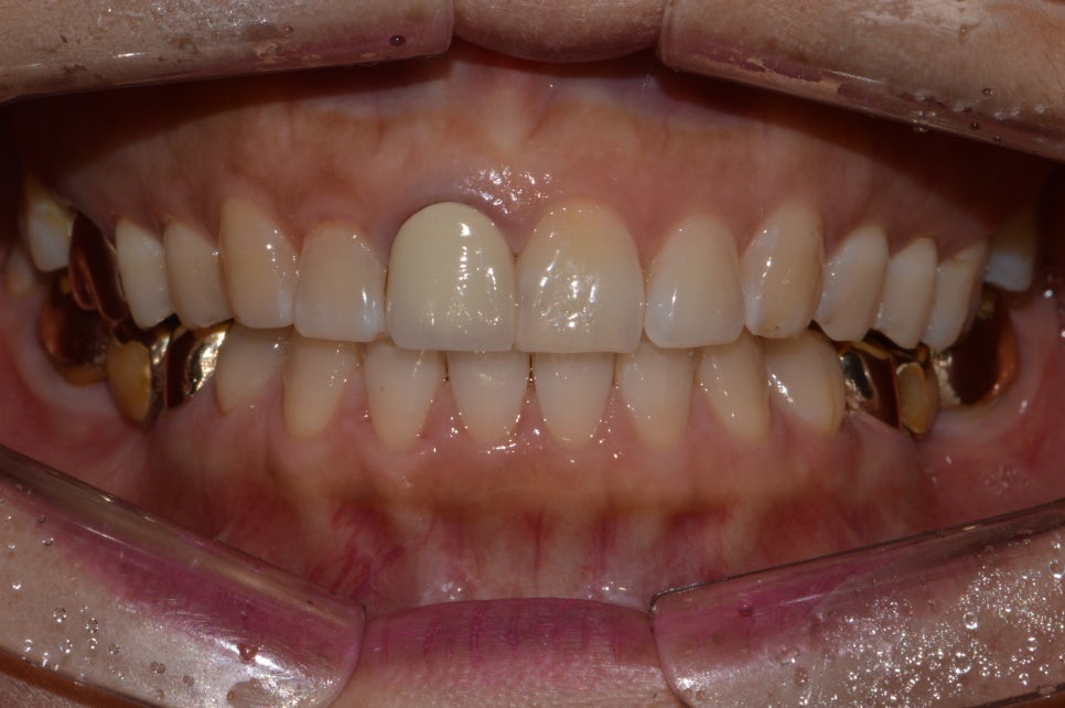 앞니 올세라믹 _재시술 (잇몸변색,메탈노출) 관련 이미지 2