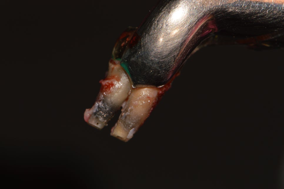 [신논현 치과] 임플란트 대신 치아재식(아름드리치과) 관련 이미지 7