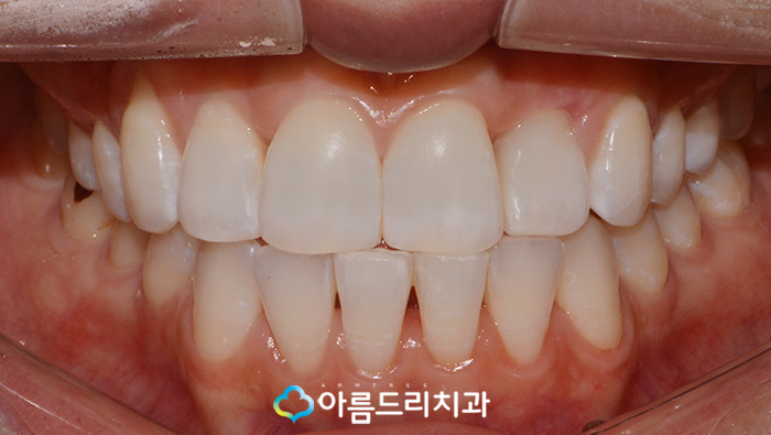 토끼이빨교정 앞니문제 해결 관련 이미지 7