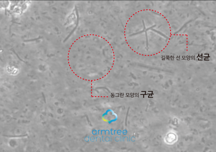 아름드리치과 이현정원장 - 스케일링 왜 중요한가? 관련 이미지 2