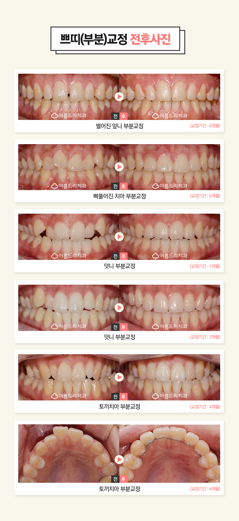 앞니부분교정후기 골라서 해봄 관련 이미지 7