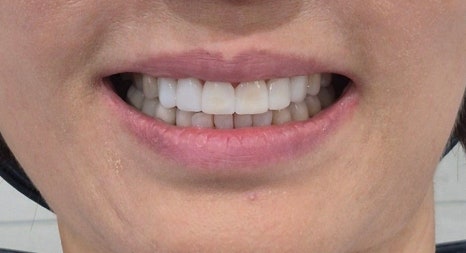 테일러 비니어 (진료일기) 관련 이미지 10