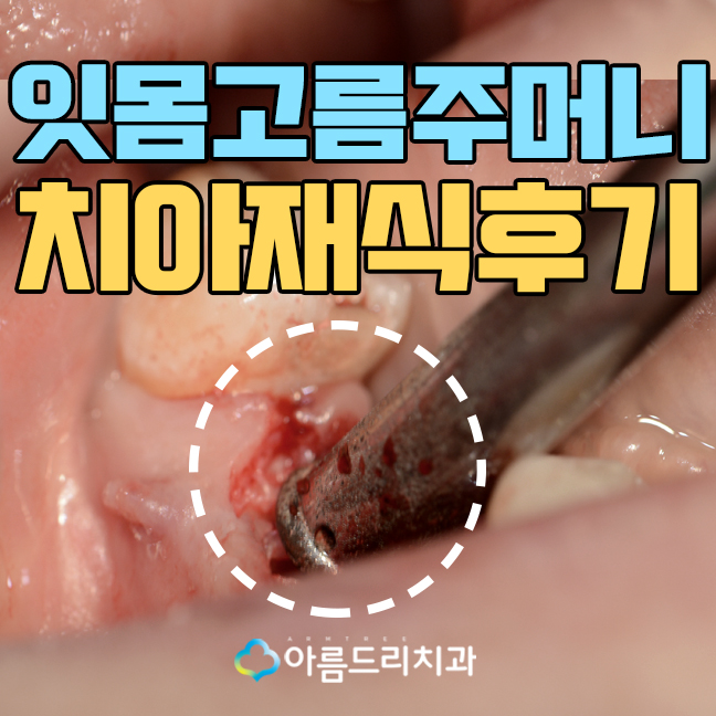잇몸고름주머니 잇몸에고름 치아재식술 치료 관련 이미지 1