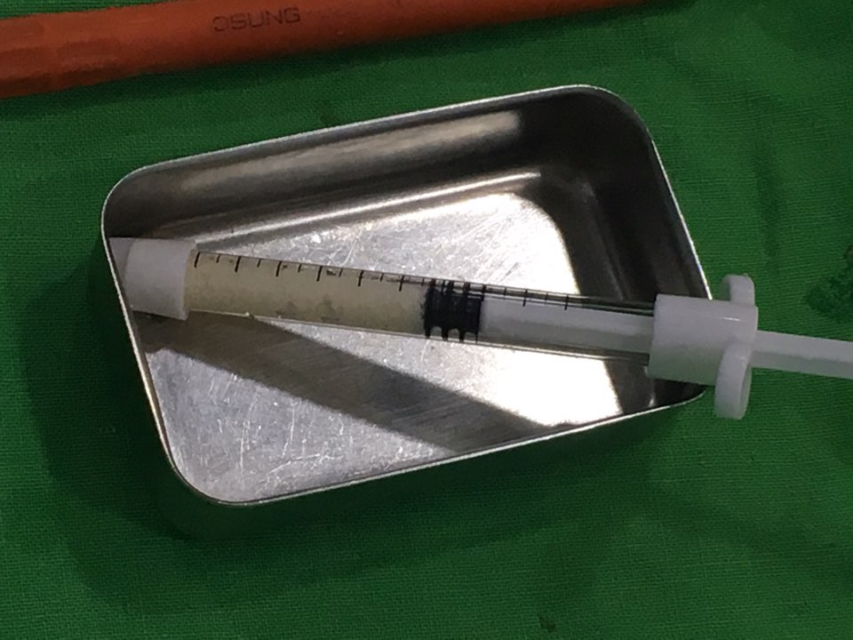 앞니 임플란트_뼈이식_신논현역 치과_아름드리 치과 관련 이미지 9