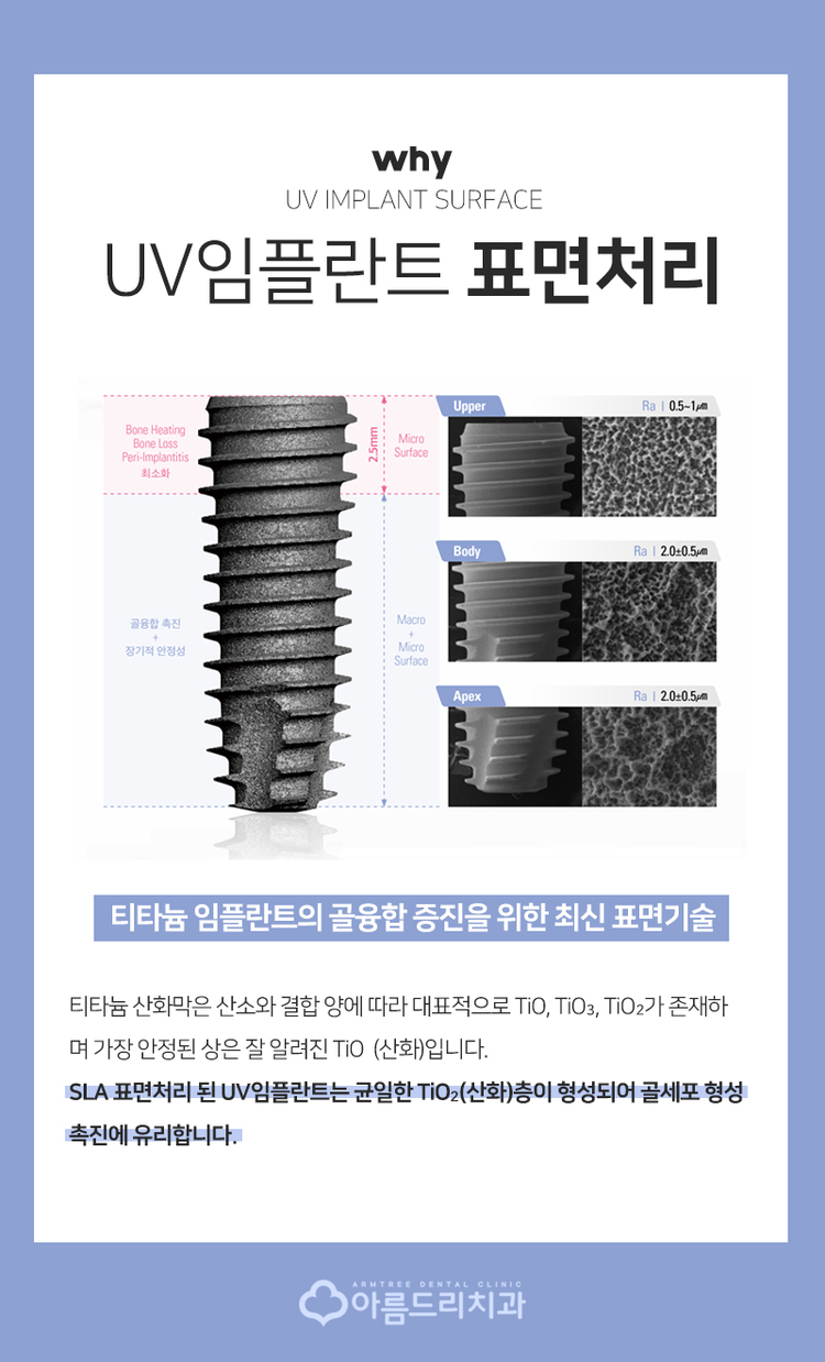 UV임플란트 더욱 완벽하게 관련 이미지 3