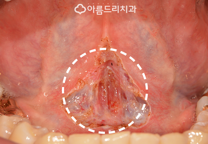 성인설소대수술 혀유착증 강남 바로알기 관련 이미지 7