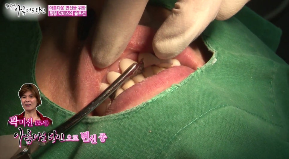 이현정원장의 아름다운 당신 시즌 1(4회 곽미선 도전자)신경치료, 심미보철, 보철치료, 올세라믹 관련 이미지 9