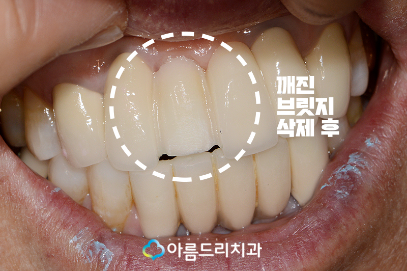 앞니 브릿지가 깨졌어요 치과치료 관련 이미지 7