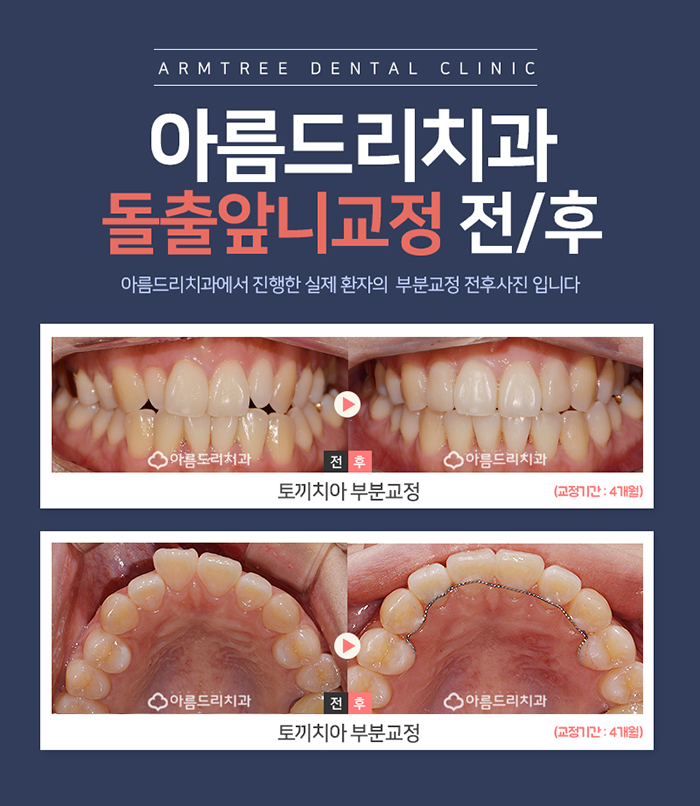 돌출앞니부분교정 제대로 알자 관련 이미지 4