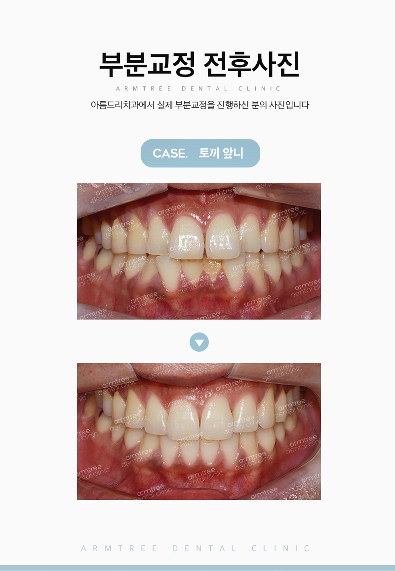 돌출앞니부분교정은 신논현역 아름드리치과에서 관련 이미지 11