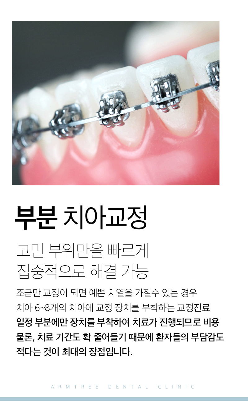 벌어진앞니교정 부분만 효과적으로 아름드리치과 관련 이미지 3