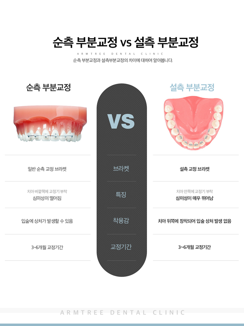 앞니부분교정 꼼꼼하고 예리하게 관련 이미지 8