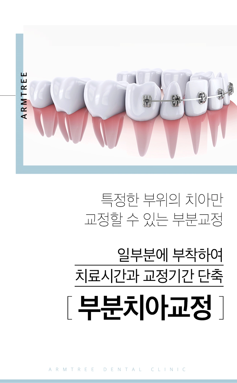 벌어진앞니교정 부분만 효과적으로 아름드리치과 관련 이미지 2