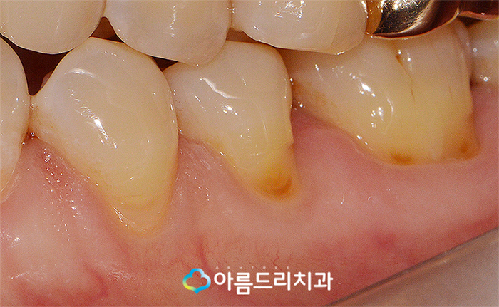 치경부마모증 잇몸파임 시린이 치료 관련 이미지 6