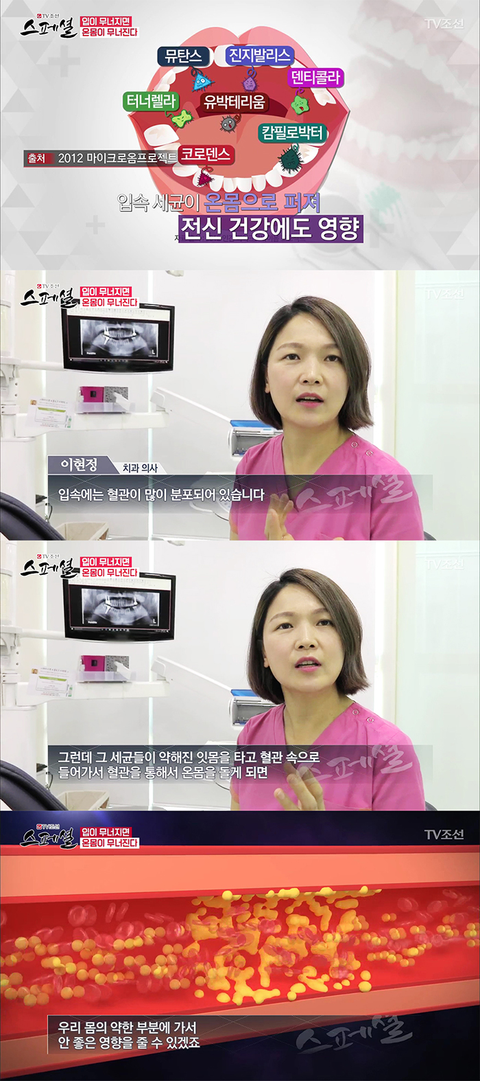 TV조선 스페셜 50회 구강건강관리 관련 이미지 9