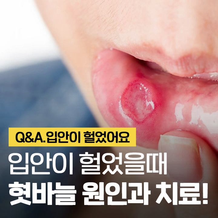 입안이 헐었을때 해결방법 이현정의물음표 관련 이미지 1