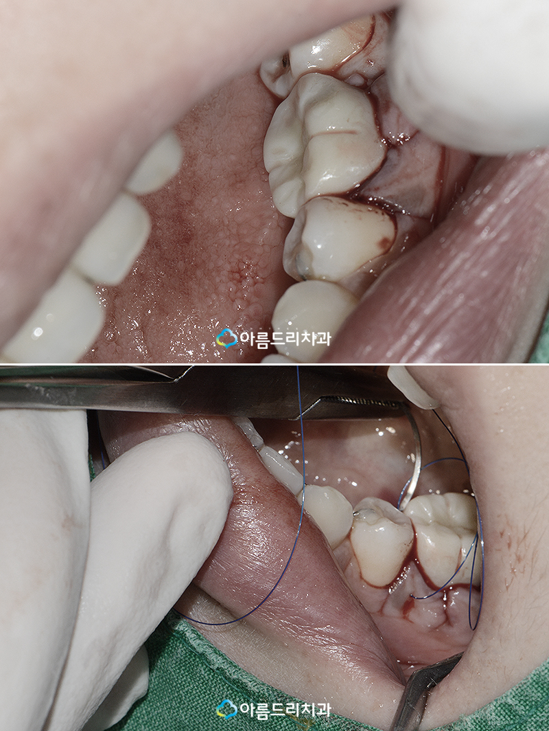 치아재식술 치료후기 자연치아살리기 관련 이미지 8